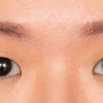 Double Eyelid Surgery Everything You Need To Know About It