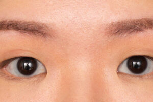Double Eyelid Surgery Everything You Need To Know About It